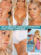 Heidi Montag scars