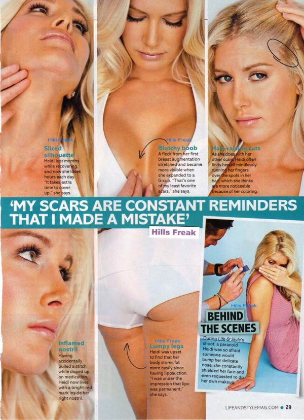 Heidi Montag scars Heidi Montag scars